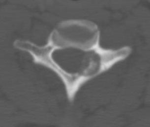 Osteoblastoma Spine0003